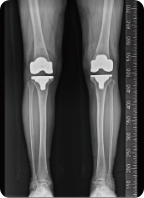 수술 후 X-ray